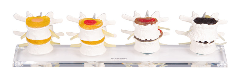 [110-250] Modèle anatomique - Dégénérescence de la colonne lombaire haut de gamme